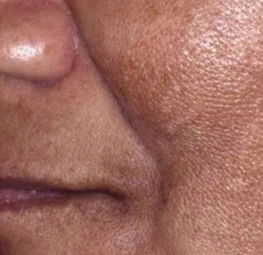 melasma.jpg